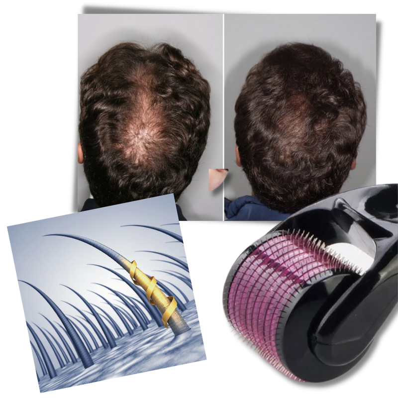 Derma-Roller für Haar- und Bartwuchs